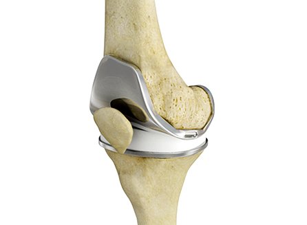 Rapid Recovery & Outpatient Joint Replacement