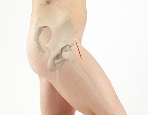  Anterior Hip Replacement