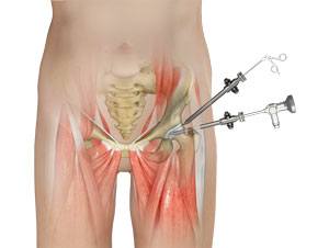 Hip Arthroscopy