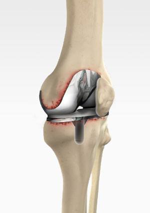 Achilles Tendon Surgery and Recovery Guide - Dr Greg Sterling