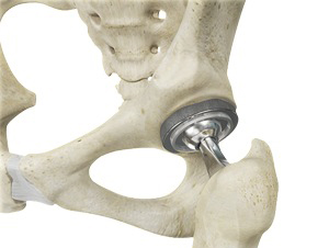 Total Hip Replacement