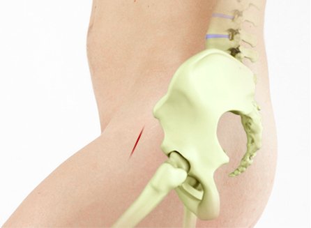 Anterior Approach-Total Hip Replacement